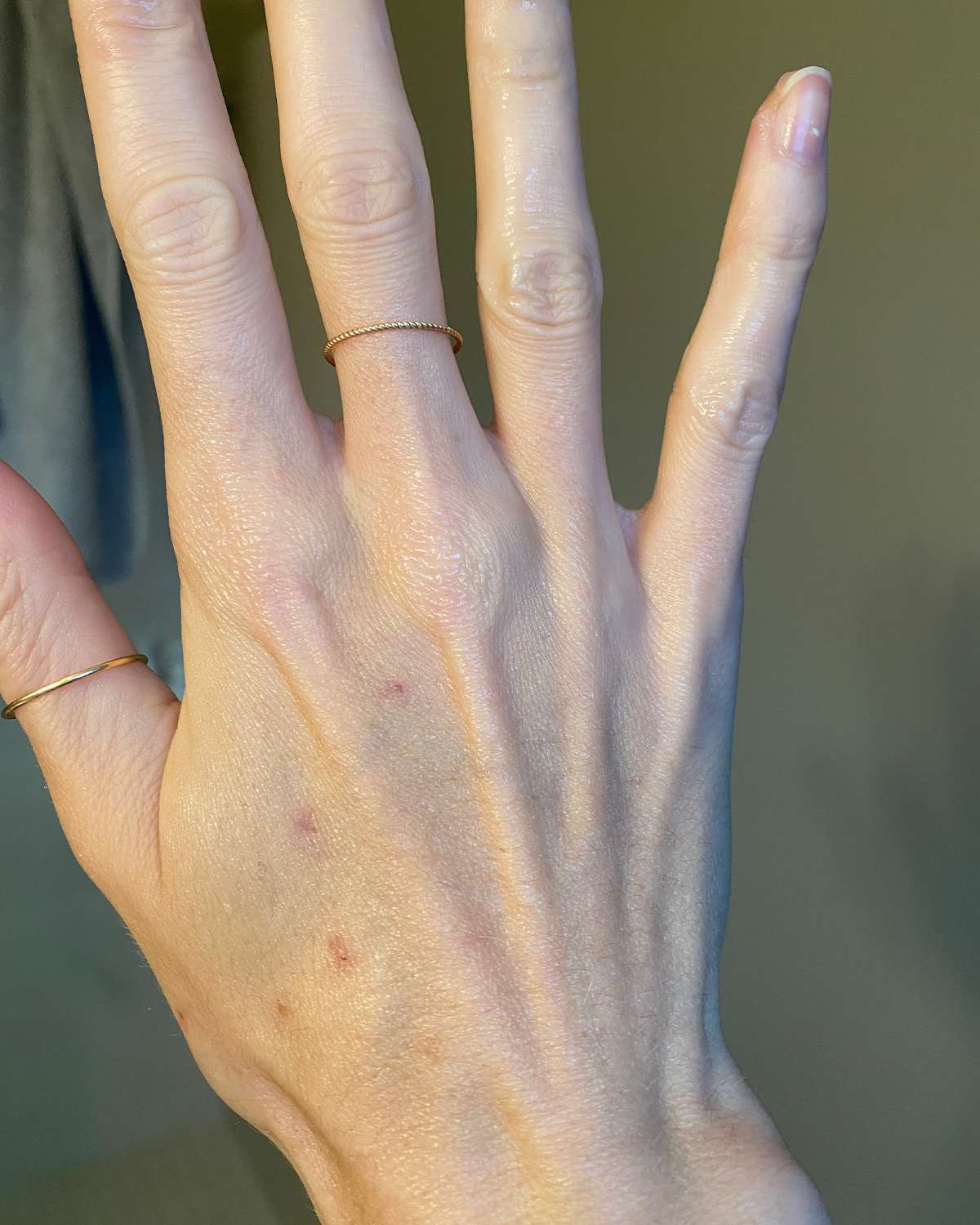 hands after sunspots treatment