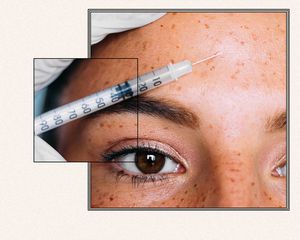 woman receiving botox injections in forehead