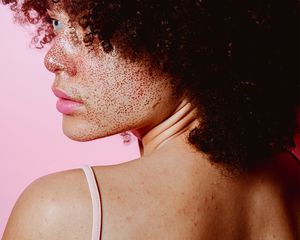 Portrait of a young woman with back acne