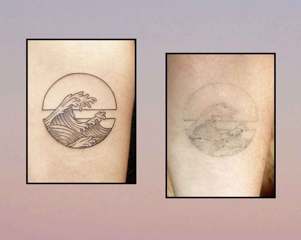 Ephemeral Tattoo Healing Process at 0 and 9 Months