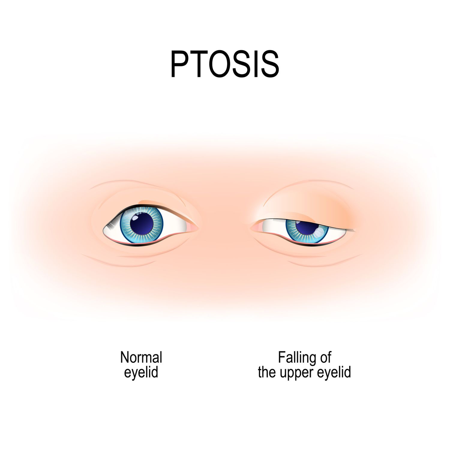 Diagram of pstosis