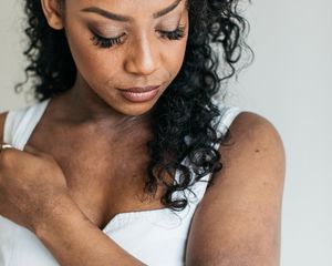 Black woman with eczema