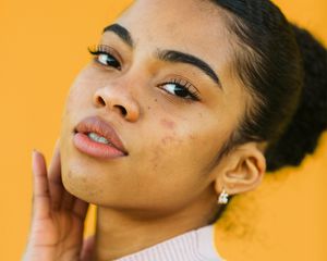 black femme with acne