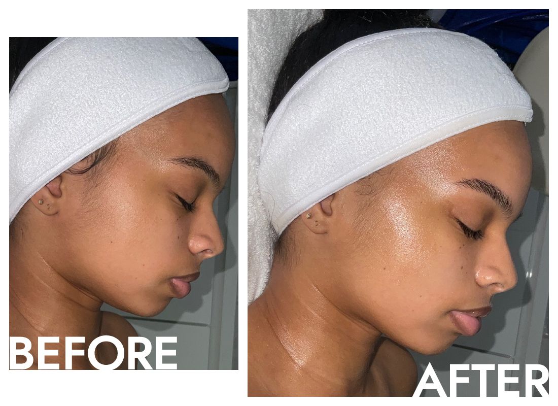 Qi Beauty facial before and after