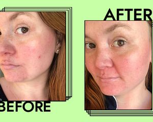 sunda riley acne oil before and after photo