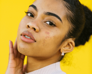 Model with acne